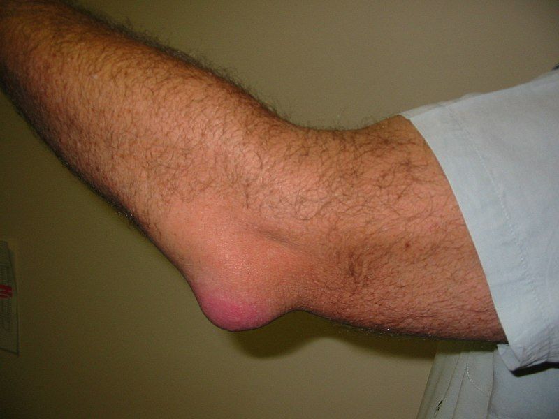 Gouty Arthritis of the Elbow