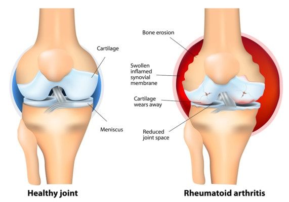 Rheumatoid Arthritis of the Elbow