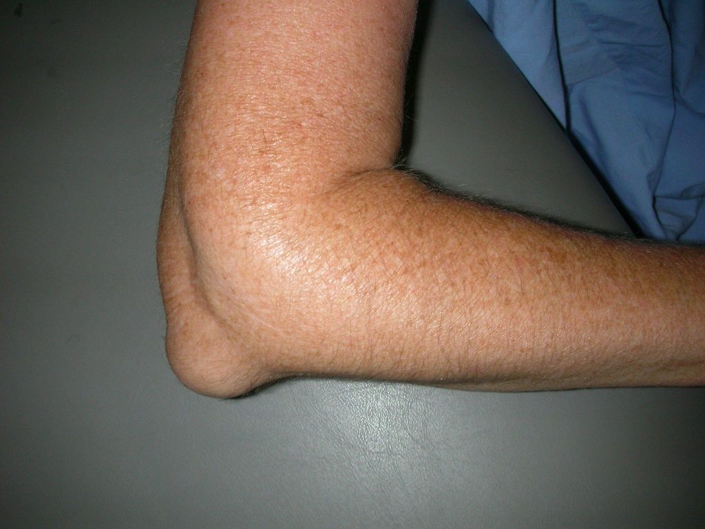 Septic Arthritis of the Elbow