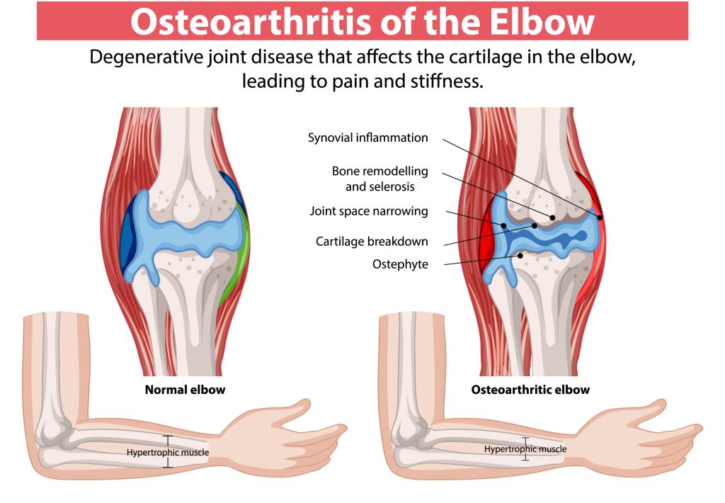 Primary Osteoarthritis of the Elbow