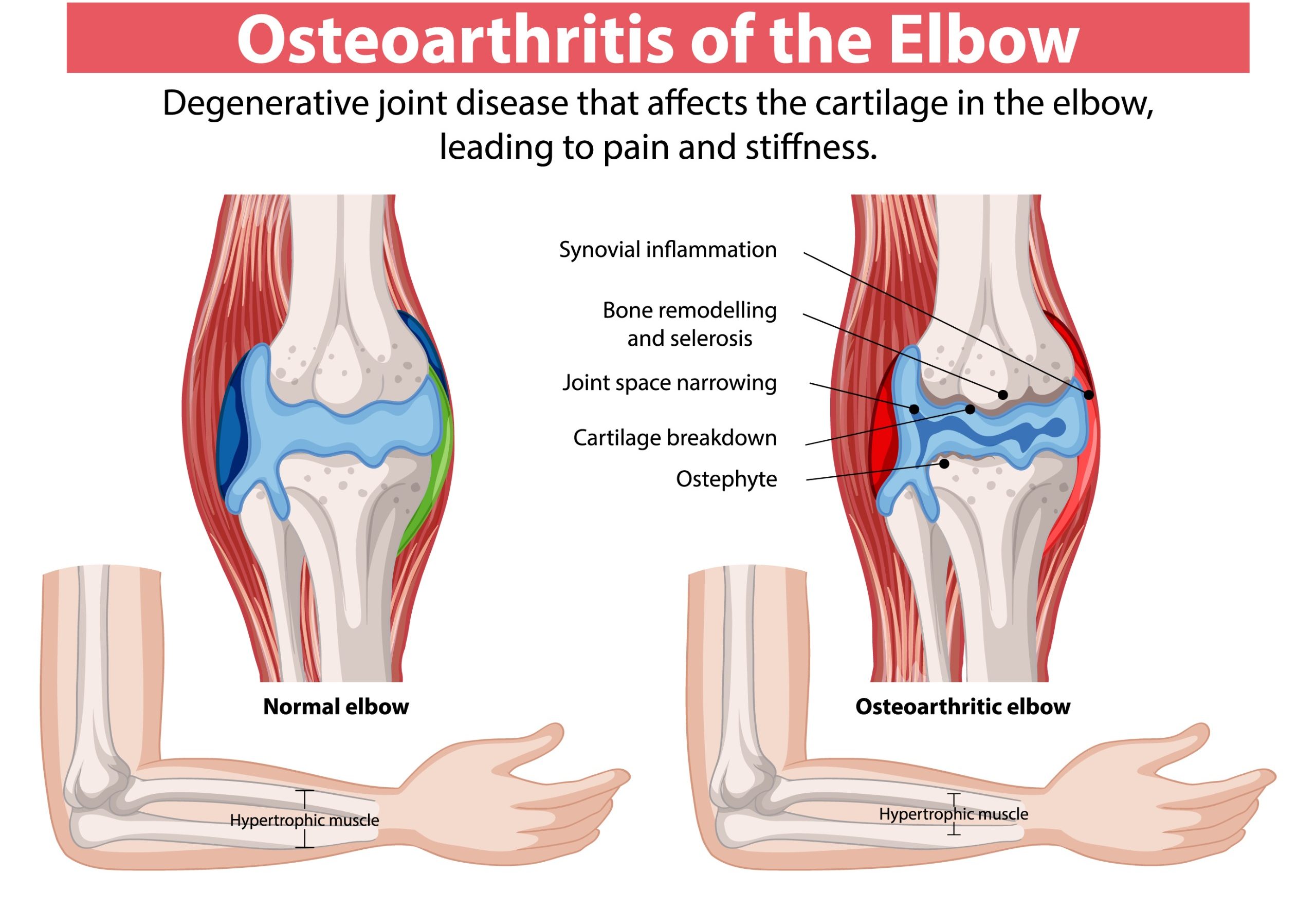 Primary Osteoarthritis of the Elbow
