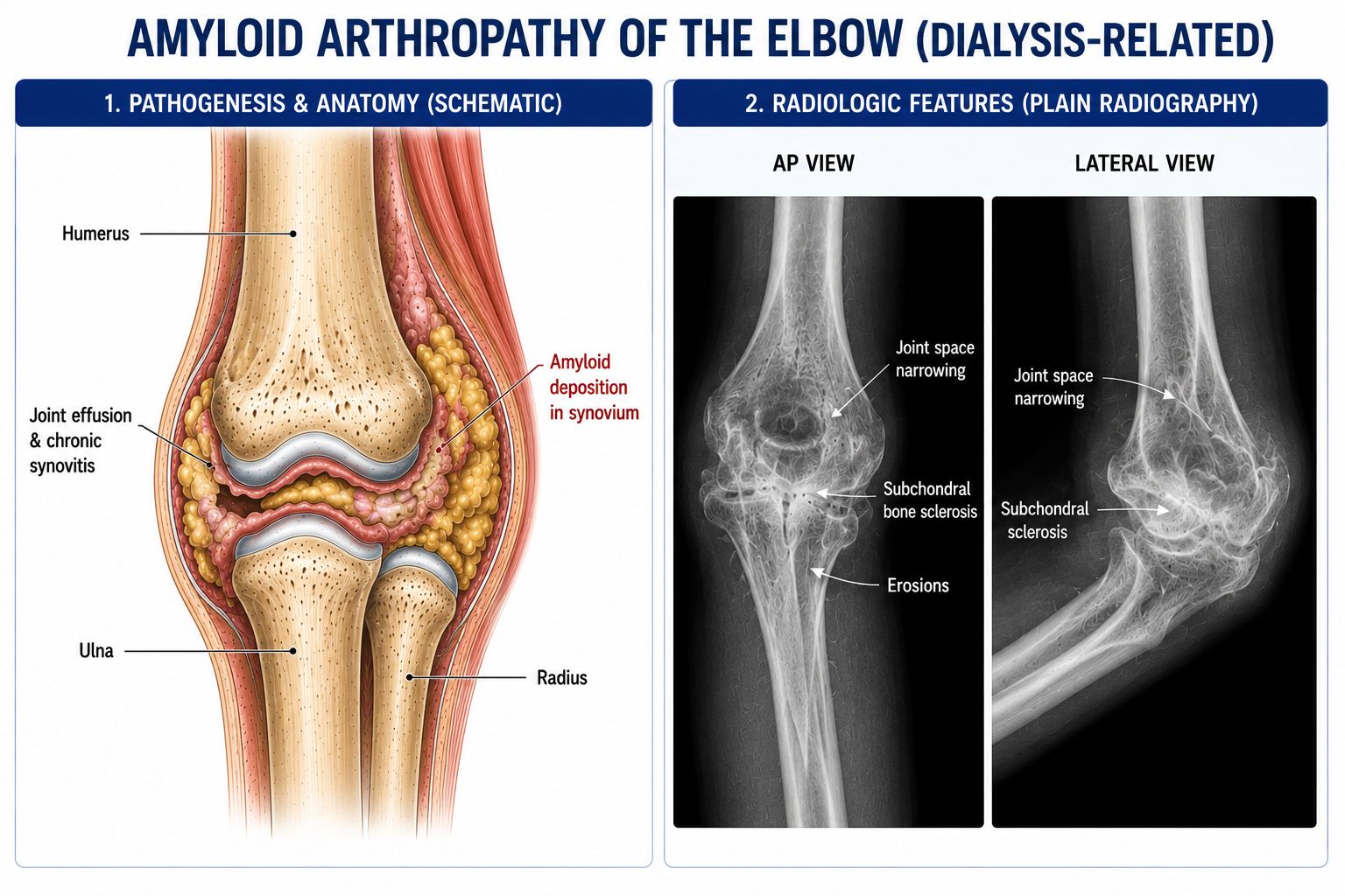 Amyloid Arthropathy of the Elbow (Dialysis-Related)