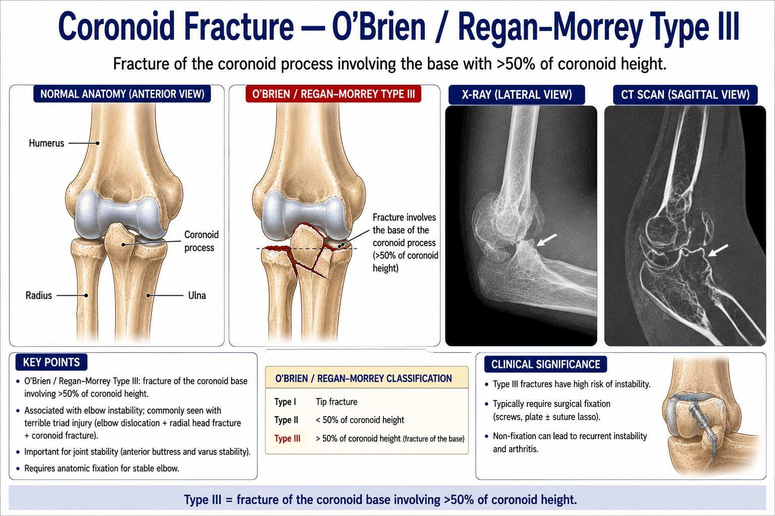 Coronoid Fracture — O'Brien / Regan-Morrey Type III