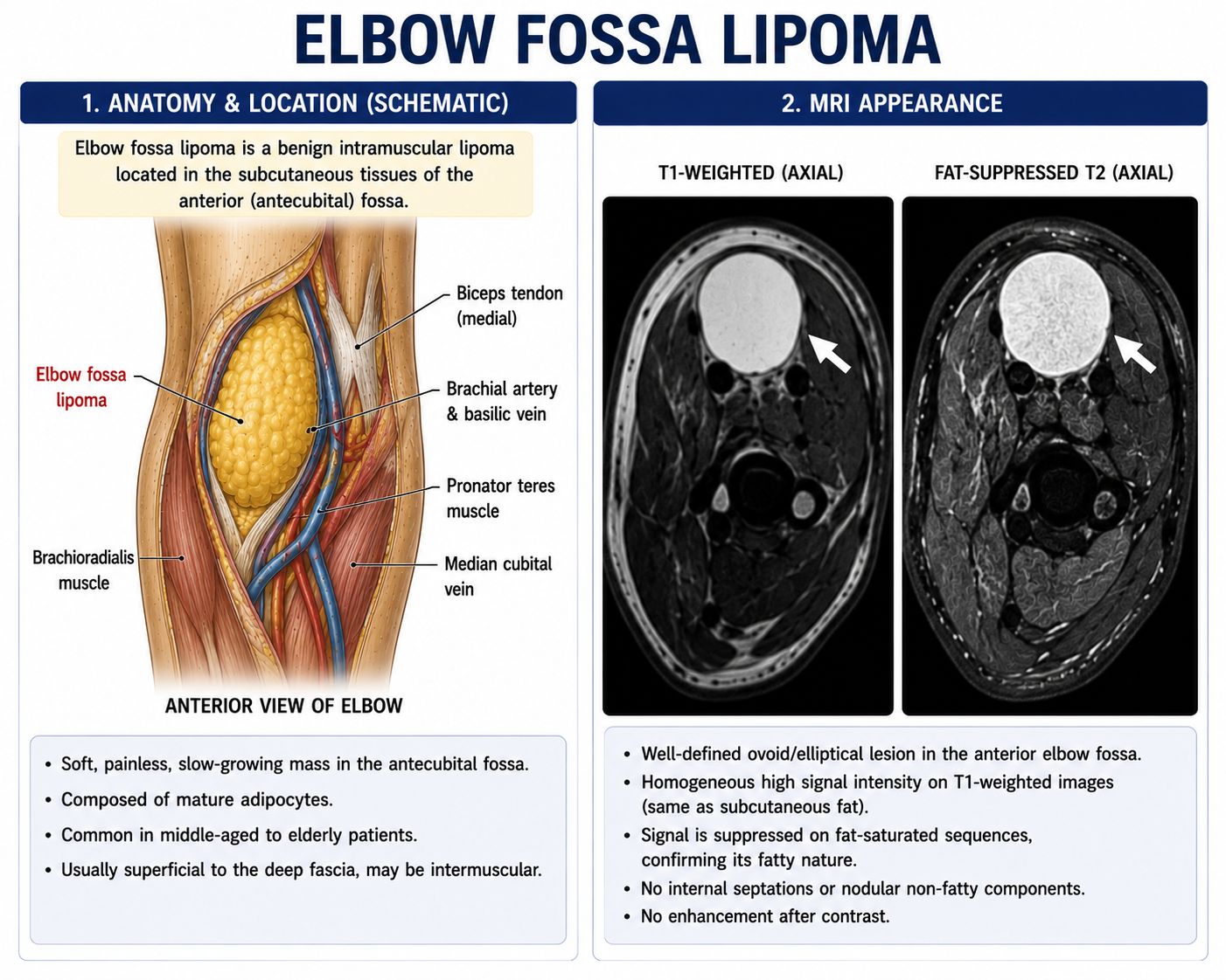 Elbow Fossa Lipoma