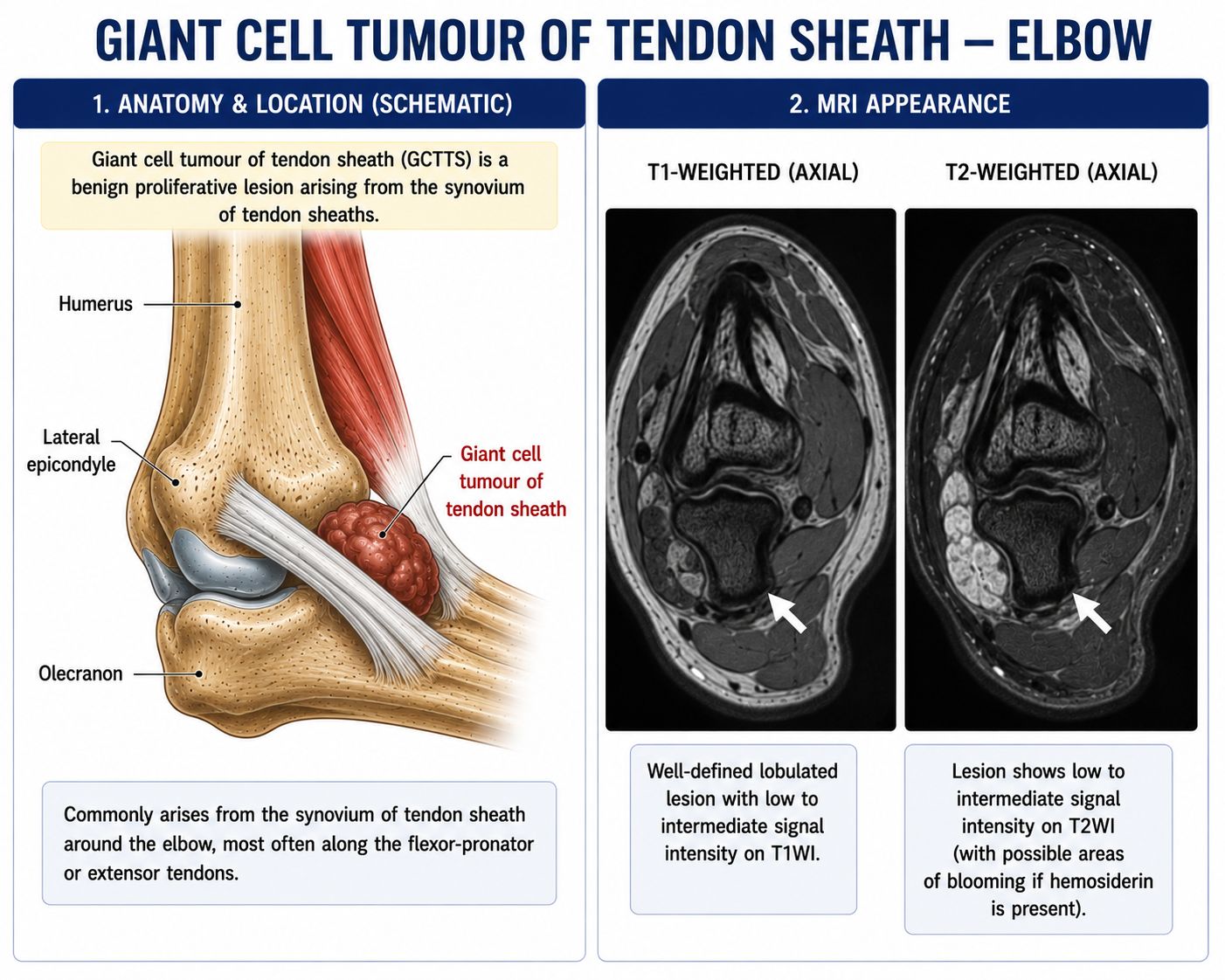 Giant Cell Tumour of Tendon Sheath — Elbow