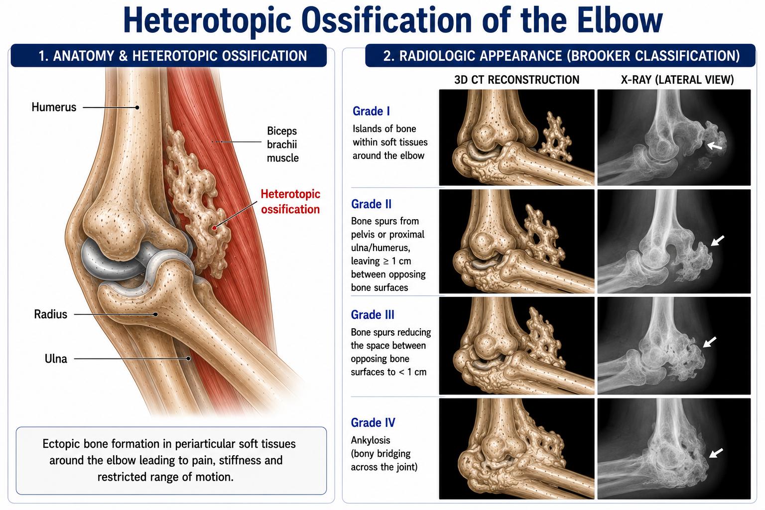 Heterotopic Ossification of the Elbow