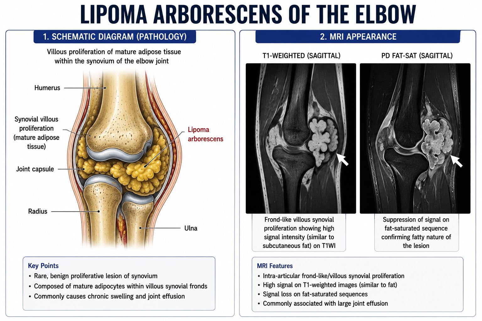 Lipoma Arborescens of the Elbow