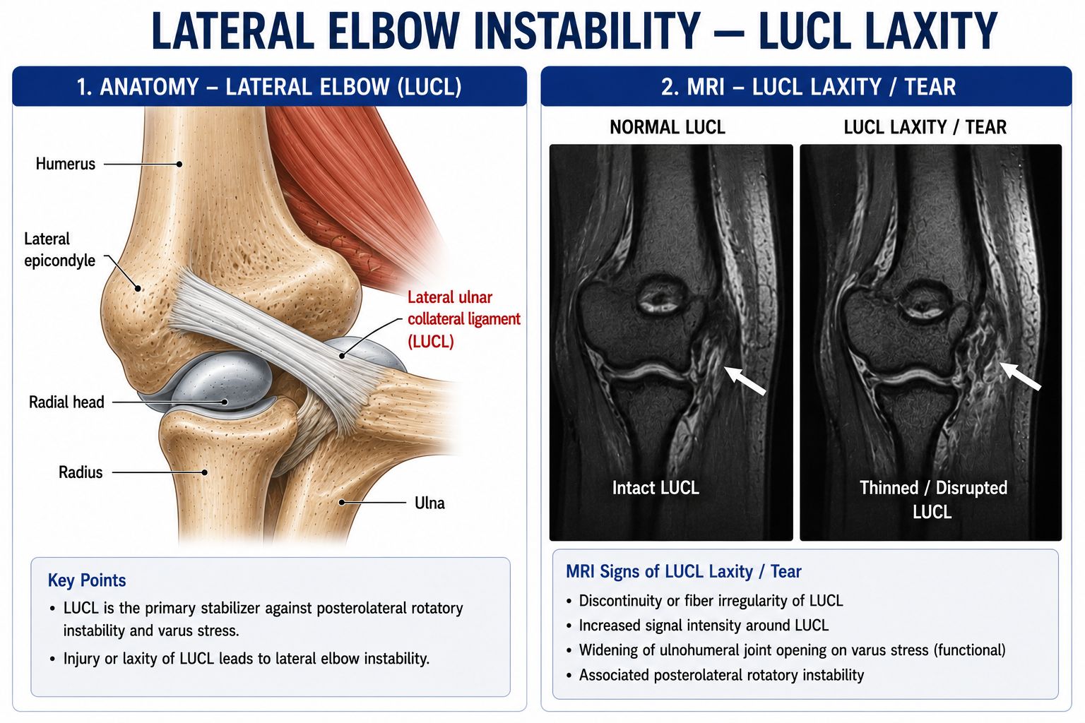 Lateral Elbow Instability — LUCL Laxity