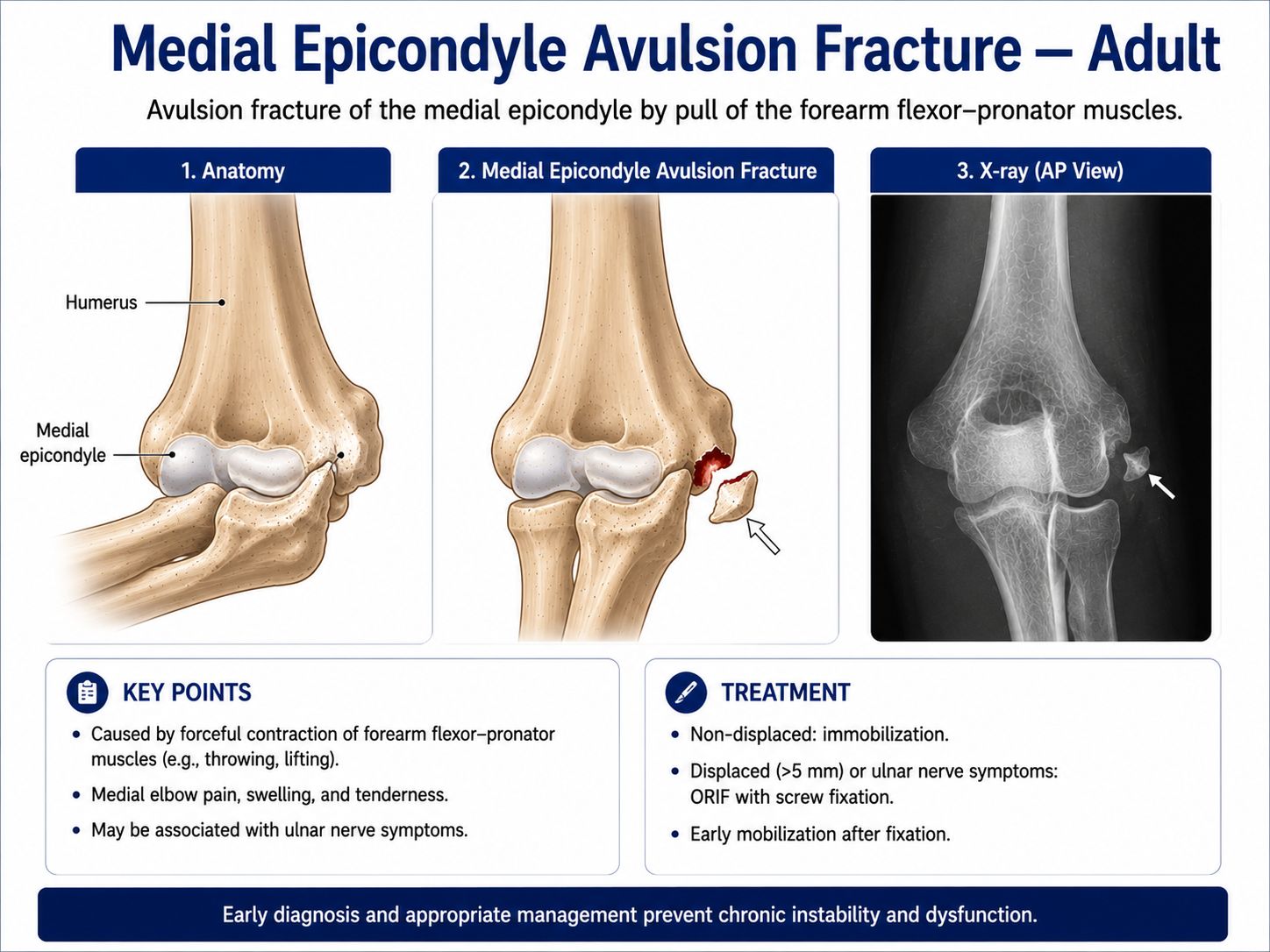 Medial Epicondyle Avulsion Fracture — Adult