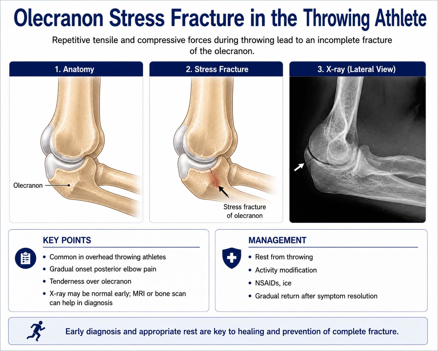 Olecranon Stress Fracture in the Throwing Athlete