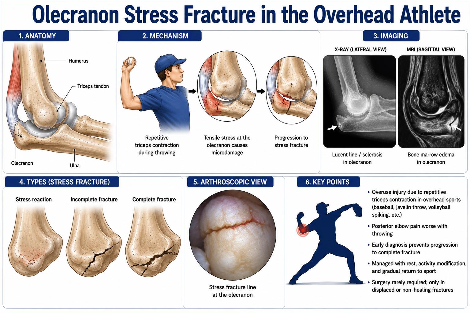 Olecranon Stress Fracture