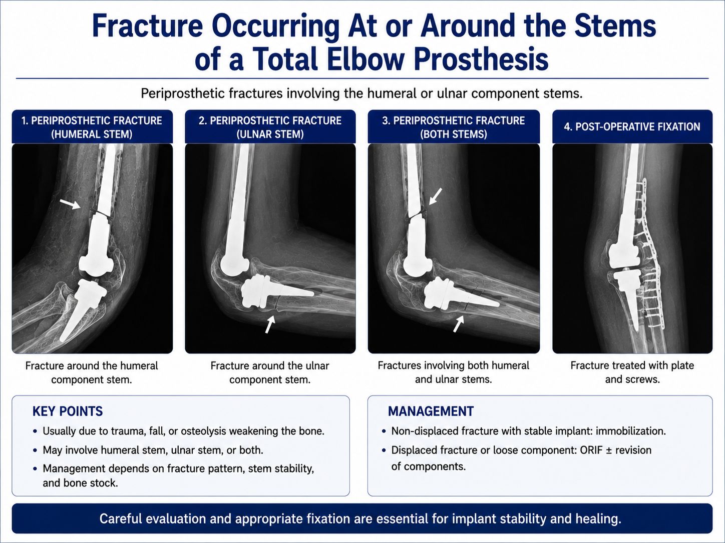 Periprosthetic Fracture Around Total Elbow Arthroplasty