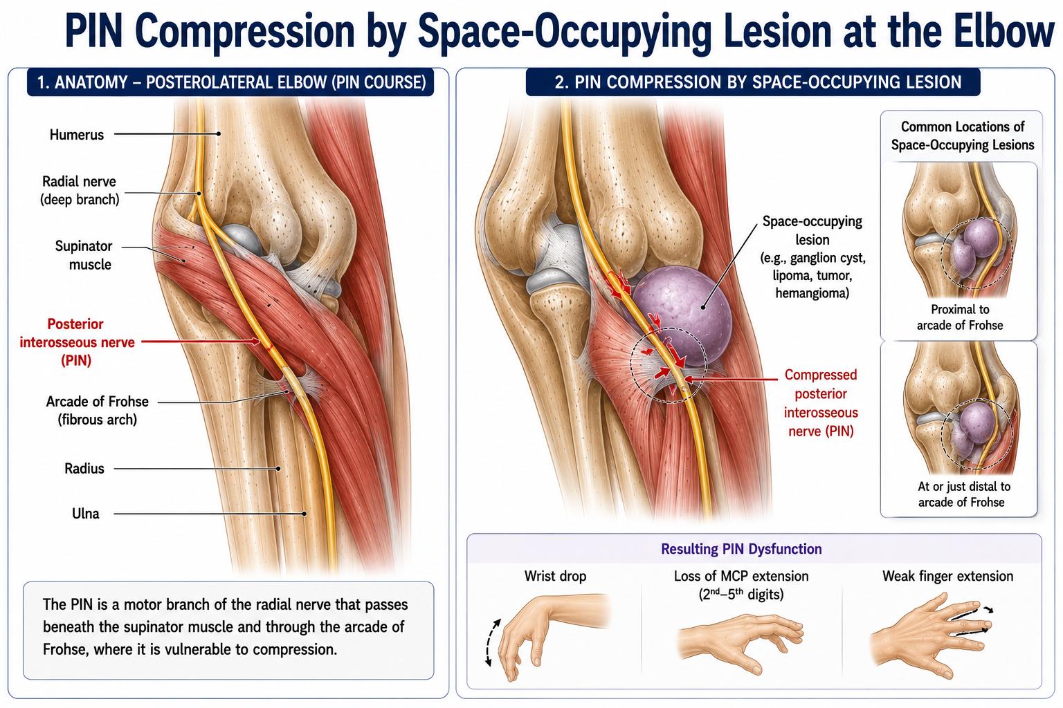 PIN Compression by Space-Occupying Lesion at the Elbow