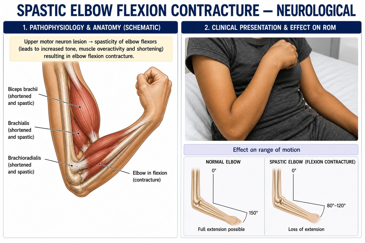Spastic Elbow Flexion Contracture — Neurological