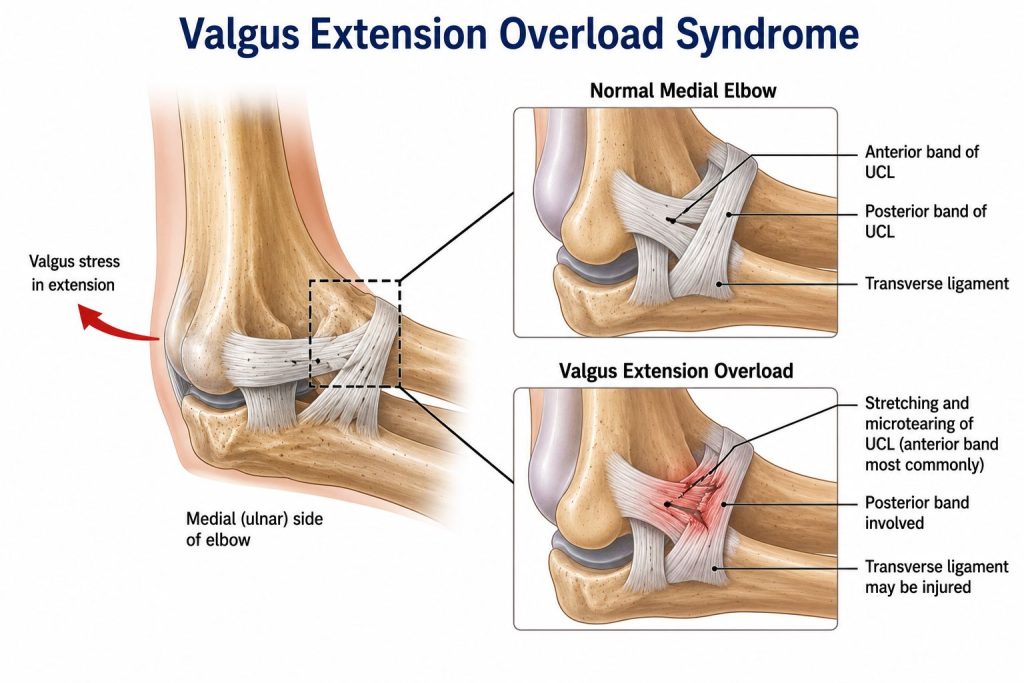 Valgus Extension Overload Syndrome