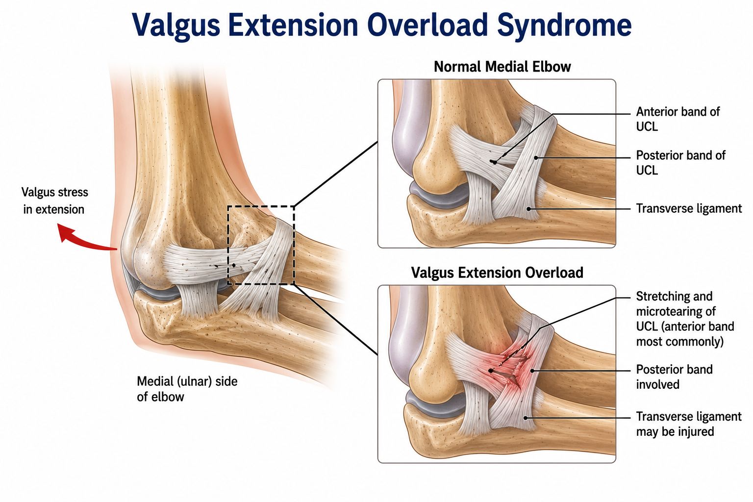 Valgus Extension Overload Syndrome