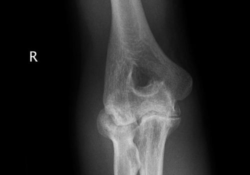 Haemophilic Arthropathy of the Elbow